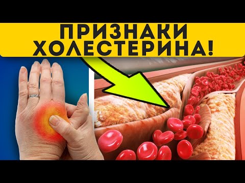 Вот как понять о повышении холестерина!