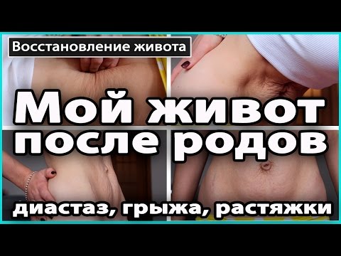 ‼️ МОЙ ЖИВОТ спустя год после родов | Диастаз, растяжки, пупочная грыжа 💜 LilyBoiko