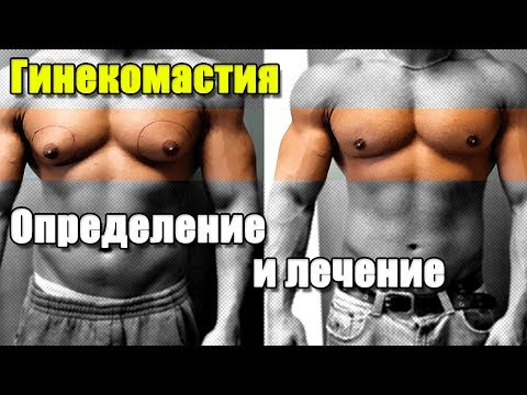 ГИНЕКОМАСТИЯ. Определение и лечение.