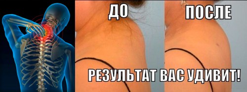 Как избавиться от холки на шее сзади
